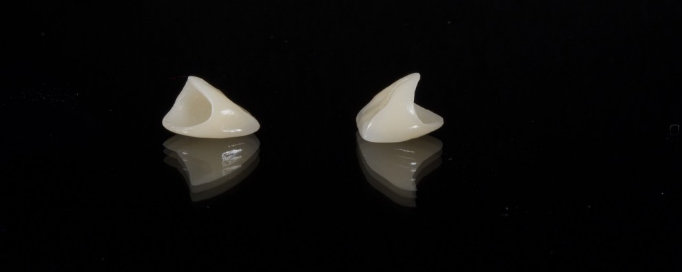 Enhancing Smiles with Veneers in Redcliffe: Everything You Need to Know